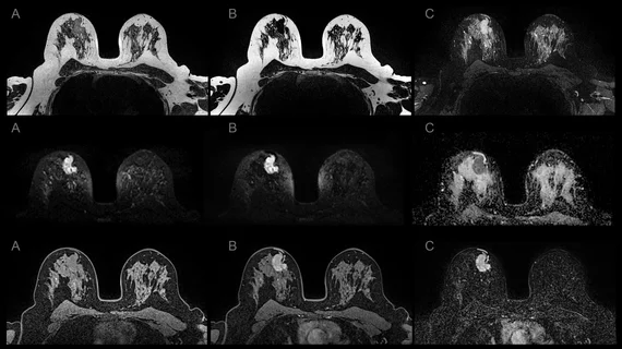 Example of various breast MRI protocol sequences that offer different types of soft tissue enhancement. Imaging performed on a Siemens Magnetom system. Breast MRI can help see through dense breast tissue to better detect cancers. #densebreasts #Breastdensity #BreastMRI
