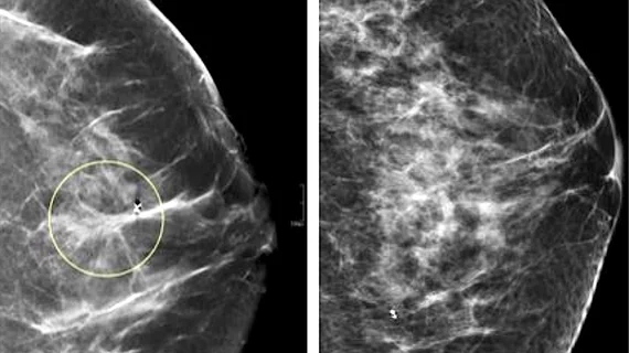 A comparison of standard 2D mammography (right) and digital breast tomosynthesis (DBT), or 3D mammography (left). The DBT creates a data set of 1 mm slices that the radiologist can look through to see more detail in suspect areas and determine if it dense breast tissue is masking a tumor.