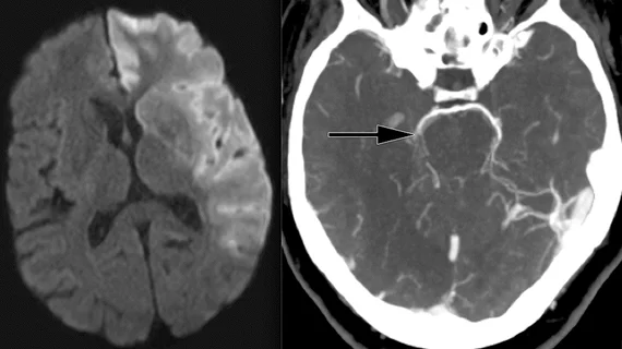 Ischemic stroke CT imaging. Images courtesy of RSNA