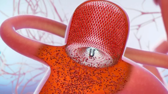 The Woven Endobridge (WEB) device to seal wide-neck intracranial bifurcation aneurysms.