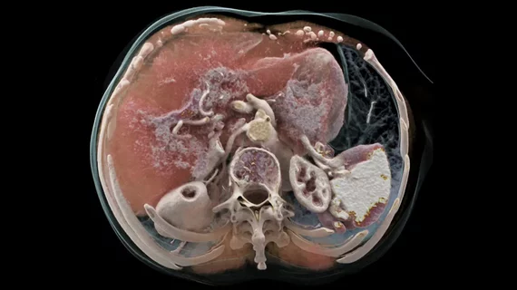 An example of a life-like 3D rendering made from a photon-counting CT scan on the Naeotom Alpha system from Siemens.