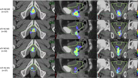 prostate cancer recurrence on PET outside of SRT guidelines