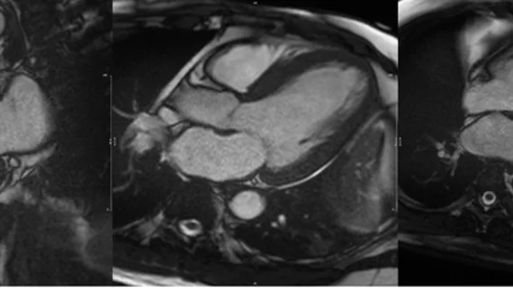 CMR of a patient showing evidence of myocardial hypertrophy