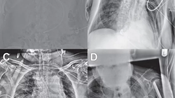 enteric tube placement on radiographs