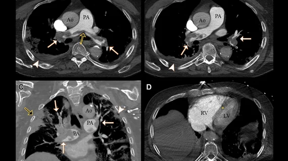 COVID causes increase risk of clotting. Example of a pulmonary embolism. CT pulmonary angiograms in a 77-year-old man with COVID-19 and a saddle embolus to pulmonary arteries (black arrow in A) extending into right and left pulmonary arteries (white arrows) in (A, B) axial and (C) coronal planes. Arrowheads show pulmonary changes associated with COVID-19 and possible lung infarction (black arrow in C). (D) Axial image at the level of the ventricles shows right-sided heart strain. RSNA. COVID PE