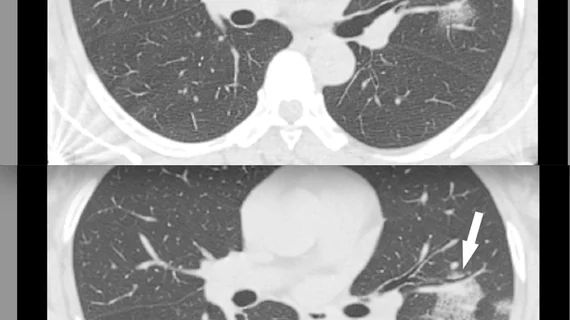 CT of coronavirus pneumonia, a solitary rounded ground-glass opacity (GGO) pattern. A 51-year-old woman in China presented in January 2020 without fever, but had close contact with positive patients. Top, baseline axial unenhanced chest CT obtained 6 days before the first positive PCR test. Bottom, chest CT scan 4 days later shows the size increase of the lesion (arrow). Image courtesy of RSNA. #COVID #SARSCoV2