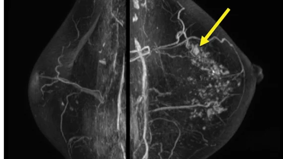 Surveillance breast MRI