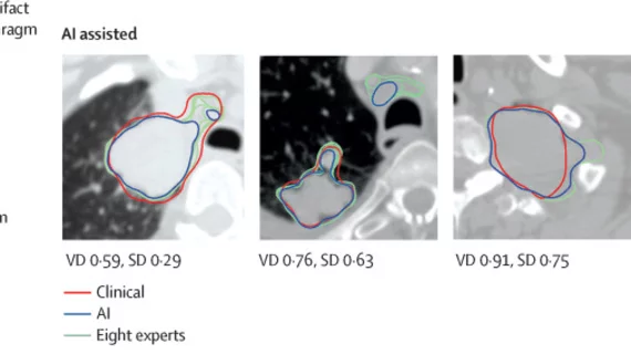 non-small cell lung cancer tumor segmentation