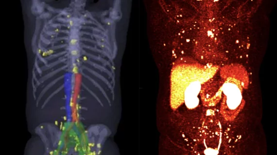 Two examples of PSMA-PET scans showing numerous prostate cancer metastases spread throughout the body. Many of these smaller tumors would not have been detected on previous standard-of-care imaging. Photo on left courtesy of SNMMI, right University of Chicago. #PSMAPET