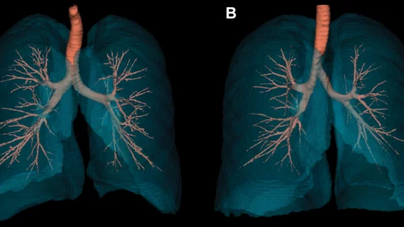 Radiology study compares the lungs of a female and male non-smoker