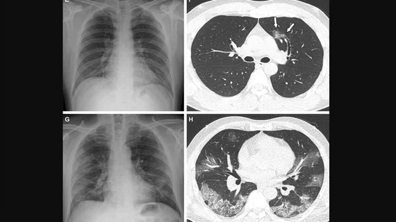 Representative cases showing pneumonia extents and patterns on chest X-ray (CXRs) and CT images. (E and F) A 36-year-old male with no history of vaccination for COVID- 19. The patient had no history of comorbidity. Axial chest CT image obtained on the same day showing unilateral ground-glass opacity with a nonrounded morphology and non-peripheral distribution in the left upper lobe (arrows). RSNA Image. COVID on X-ray, CT scan. What does COVID look like in medical imaging? Example of COVID imaging.