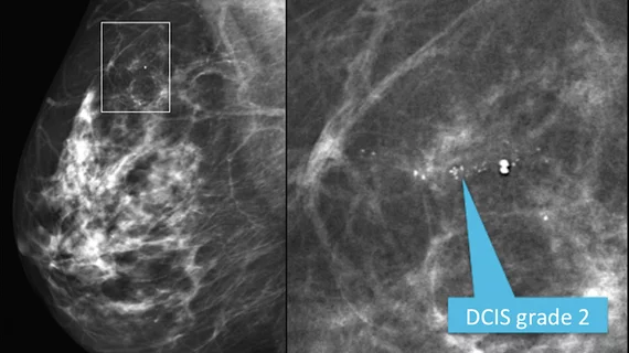 Why the way microcalcifications on mammograms are regarded could