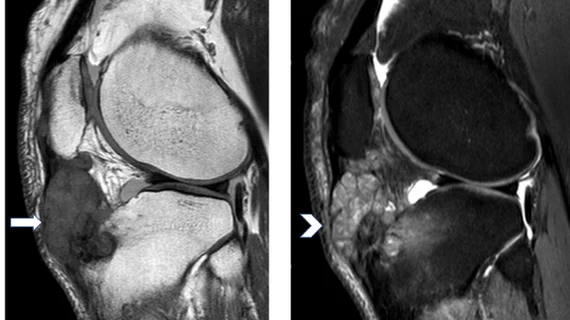 bone and soft tissue tumors