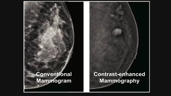 Contrast-enhanced mammography uses iodine contrast injected into a patient and mammography system to image contrast uptake or areas of increased vascular activity, which is typical of cancers. This can help image through dense breast tissue to find cancers that are otherwise masked by dense breast tissue.