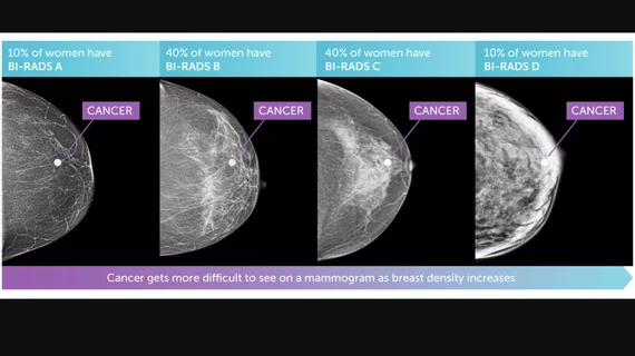 Illustration of the four types of breast tissue densities. The more dense, the harder it is for radiologists to detect cancers, which had led to about 40 states to now require notiofication of patients if they have dense breasts and the impact on their care, with possible miss-reads and that they may need supplemental imaging. 