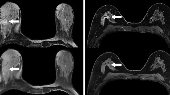 synthetic contrast-enhanced breast MRI