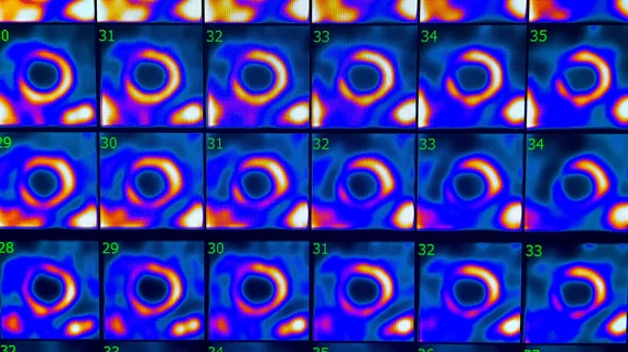 Cardiac SPECT perfusion exam using Mo-99 based technetium 99m, which makes up the vast majority of cardiac perfusion imaging exams. Photo by Dave Fornell