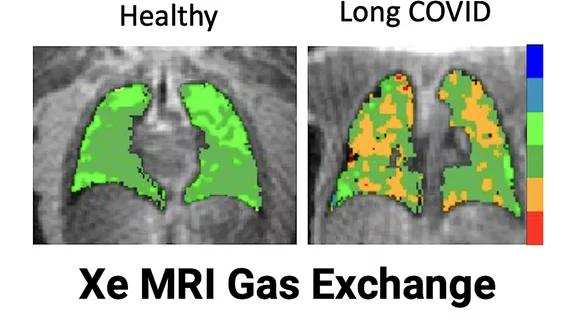 Sean Fain, PhD, vice chair of radiology and research and a professor of radiology, Division of Cardiovascular and Thoracic Imaging, University of Iowa, discusses how long-COVID lung damage can be tracked using xenon (Xe) gas magnetic resonance imaging (MRI) and quantitative computed tomography (CT). He spoke to Health Imaging at RSNA 2022. 