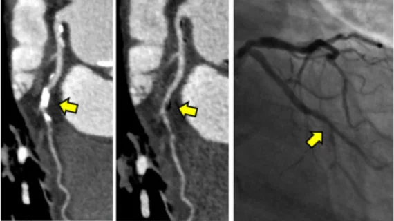 subtraction coronary CT angiography