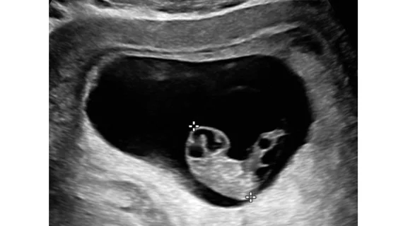 As the pregnancy advances, the embryo is easier to see, and accurate measurements can be obtained with transabdominal ultrasound. A crown-rump length (CRL) measurement. This ultrasound scan shows the CRL, which is the average of discrete fetal measurements from the tip of the head end to the tip of the rump end in the midsagittal plane of the embryo. This is highly accurate for pregnancy dating. Images courtesy of RSNA