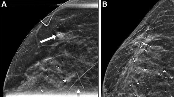 DCIS recurrence on mammogram