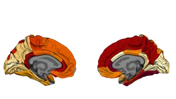 #obesity #alzheimersdisease #alzheimersresearch #neuroimaging #brainMRI