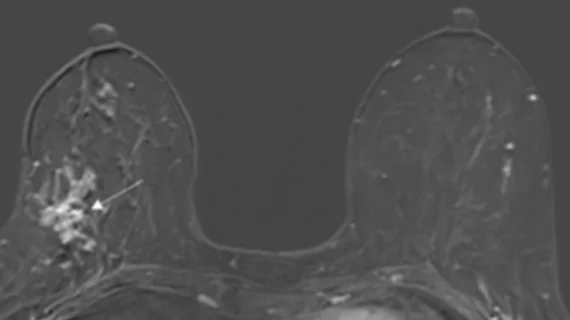 #DCIS #invasivebreastcancer #cancerupgrade #breastMRI