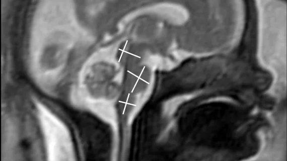 MRI image of a fetus inside the mother on an MRI scan to assess brain development. Image courtesy of RSNA.