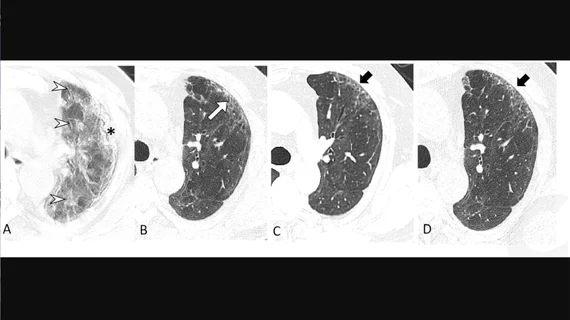 Serial transverse CT scans in a 65-year-old man with severe COVID-19 from 23-days after infection to 2-year follow up. The newest followup images on the right showed presence of subtle, subpleural honeycombing at the same area (black arrows). Image courtesy of Radiology. #longcovid #covidlonghauler #lungdamagecovid