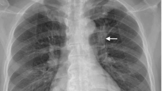 lung cancer imaging features associated with worse outcomes following missed diagnosis