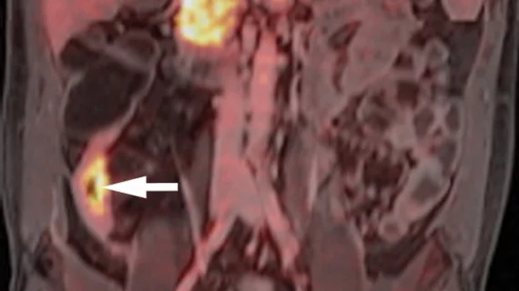 PET/MRI of FAPI radiotracer uptake in Crohn's disease