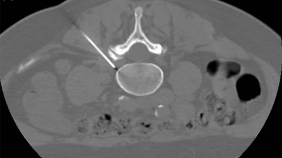 pulsed radiofrequency for sciatica