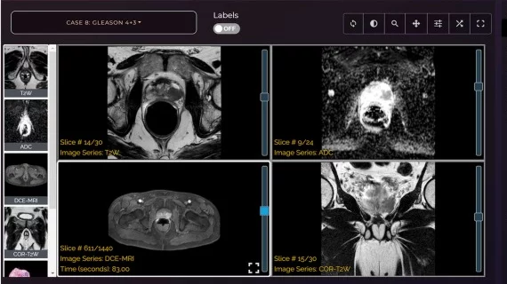 Learning app improves reader performance for prostate MRI