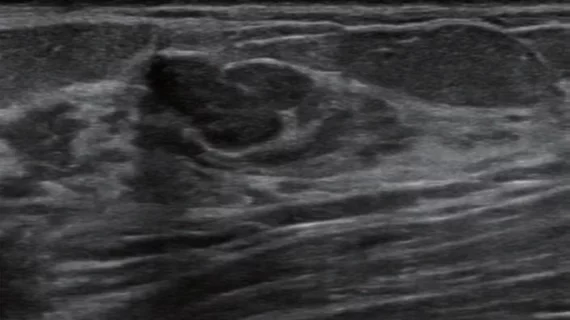 lesion on breast ultrasound