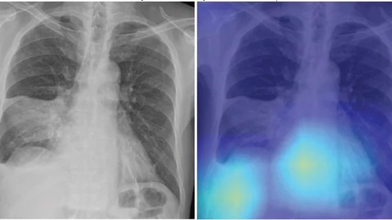 A figure from the study shows a chest radiograph with an area of consolidation involving right lower lung consistent with pneumonia, as well as right pleural effusion. The deep-learning model predicted risk of 30-day mortality of 9%. Right: Gradient- weighted class activation map shows that model prediction was influenced by separate area of image corresponding with heart and liver (yellow and light blue colors). Patient’s CURB-65 score was 4. Patient recovered from pneumonia and remained alive. AJR Image