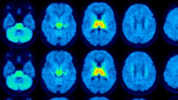 molecular imaging study on brain connections in obese individuals