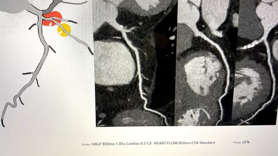 HeartFlow's RoadMap technology where AI reads the image in a first pass to highlight areas of interest with for the radiologist or cardiologist on coronary CT scan. The technology was shown to reduce reading time by 25%.