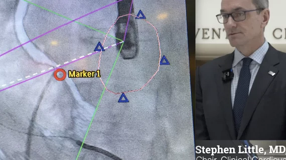 Video of ASE President Stephen Little, MD, discussing trends in interventional echo at the ASE 2023 annual meeting.