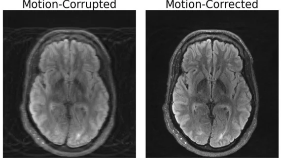 Motion-Corrected MRI Scan