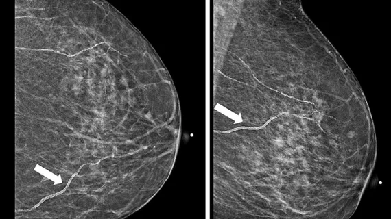 Breast arterial calcifications (BACs) identified on screening mammograms may help identify women who face a heightened risk of developing cardiovascular disease (CVD), according to a new analysis published in Clinical Imaging.