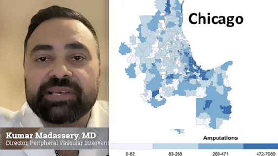 On the frontline of the epidemic of peripheral artery disease (PAD) and related 400 leg amputations per day in the U.S., Kumar Madassery, MD, director of peripheral vascular intervention and critical limb ischemia (CLI) program at Rush University Medical Center in Chicago, explains there is a glaring health inequities in rural and low income areas of the country.