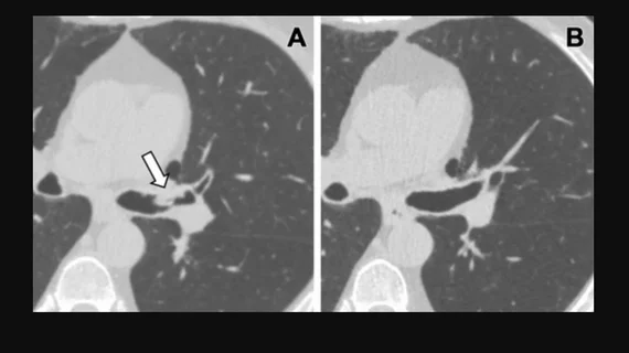 Lung cancer screening CT image in a 66-year-old male patient shows a sessile nodule with internal air in the left mainstem to left upper lobe bronchus (arrow) with a mean diameter of 10 mm. The nodule was assigned as Lung-RADS category 4A in the clinical report. (B) Follow-up CT image shows the lesion is resolved. Image courtesy of RSNA