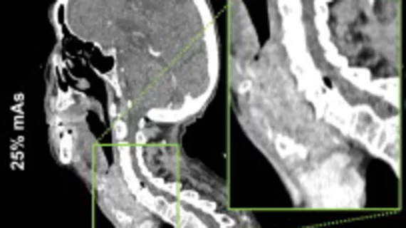 deep learning algorithm slashes radiation dose during neck CT scans