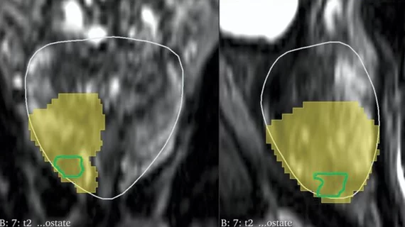 AI assistance improve prostate cancer margin definition