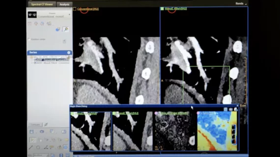 Example of pulmonary embolism (PE) detection on CT and confirmed using spectral CT. Image courtesy of Philips Healthcare