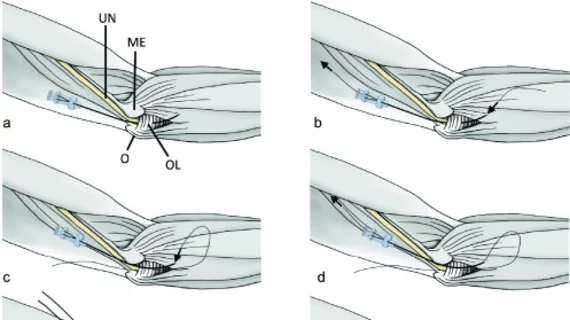 New IR procedure for cubital tunnel syndrome