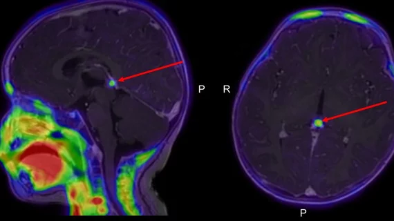 New PET technique improves imaging of pediatric neuroblastoma.