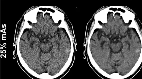 Deep learning denoising produces quality trauma head CT images at 25% of the radiation dose