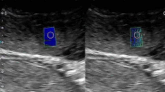 Ultrasound shear-wave elastography predict fetal growth abnormalities earlier than routine obstetric exams.