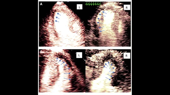 Ultrafast/high frame rate myocardial contrast echocardiography 